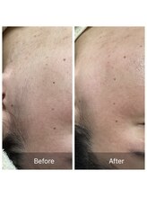 ダリア(Dahlia)/お顔のワックス脱毛