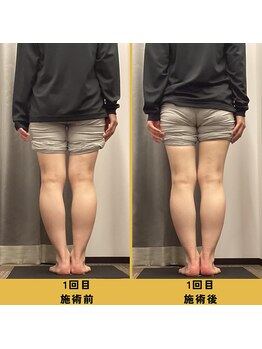 ベル/【20代会員様】O脚矯正の変化