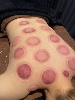 リレス(Riless)/カッピング