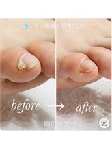 名古屋巻き爪専門Pro/【副爪】小指横の角質