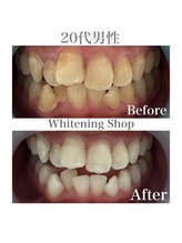 ホワイトニングショップ 広島廿日市店/before&after