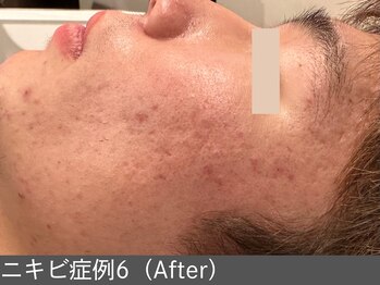 オアシスラグーン(OASIS LAGOON)/ニキビ改善(症例6 after)