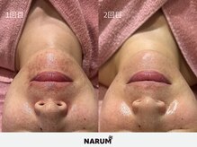 ナルムフェイシャル 代々木(NARUM facial)の雰囲気（繰り返すニキビ・毛穴詰まり、増えるシミを終わらせる）