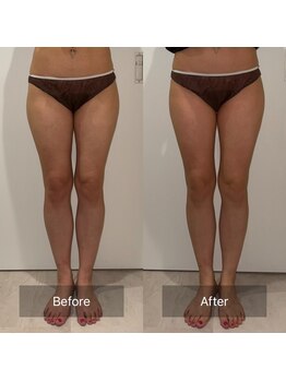 ケアナ 梅田(CareNa)の写真/たった60分でこの変化★ハイパーナイフ×メロンボトル×熟練ハンドで本気痩身