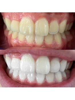 エクシアホワイトニング 日本橋店/ビフォーアフター