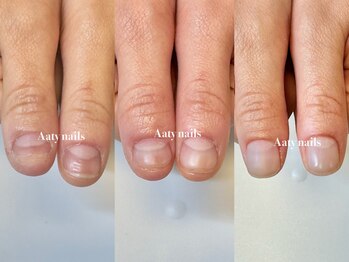 アーティネイルズ(Aaty Nails)/深爪から普通の爪、更に美爪へ