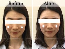 ハリラウンジ 恵比寿本店(Hari Lounge)/美容鍼専門サロン Hari Lounge