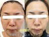 Lit 幹細胞トリートメント再来のお客様限定
