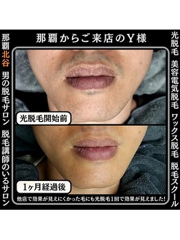 ディースタイル 北谷店(Dstyle)/北谷メンズ脱毛ヒゲBefore After
