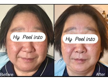 ル リアン(Le lien)/水素ケア!グロス肌ピーリング