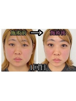 シャルム(Charme)/小顔矯正施術１回