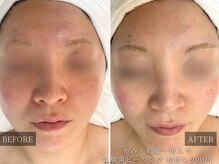 ピュア(pure)の雰囲気（≪ 人気No.1初回価格 ≫乳酸菌ピーリング9,900円）