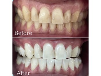 ホワイト 福岡天神店(WHITE)/６ヶ月継続ビフォーアフター