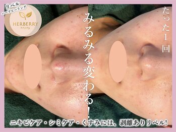 ハーバリー ハーブピーリング 金山店(HERBERRYハーブピーリング)/名古屋ハーブピーリングHERBERRY