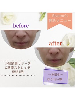 リヴェーヌ 呉羽店(Riverne)/ホウレイ線も薄っすら！