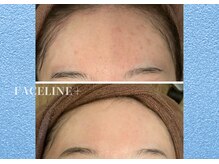 シンメトリー 銀座店/BIOPHYTO×デコルテ骨気