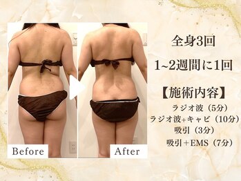 ミスティア(mistia)/【セルフエステBA】全身