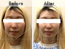 ハリラウンジ 恵比寿本店(Hari Lounge)/美容鍼専門サロン Hari Lounge