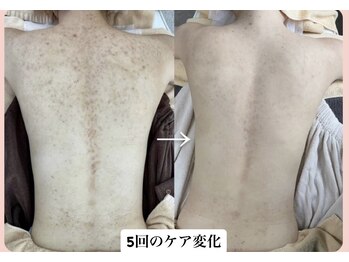 スキンハピネス(skinhappiness)/背中ハーブピーリングケア