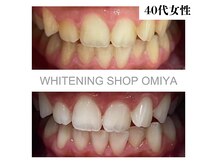 ホワイトニングショップ 大宮店/【事例】　40代　女性