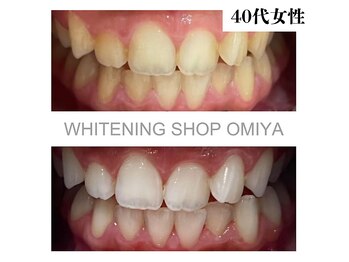 ホワイトニングショップ 大宮店/【事例】　40代　女性