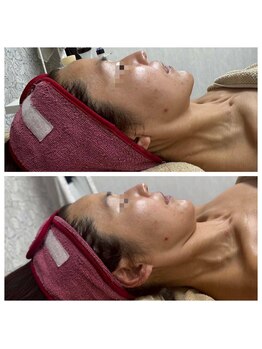 シェイプ 浜松本店/たるみケアー