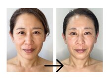 コトハ(cottha)/1回施術後