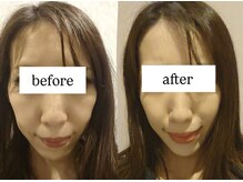 ビー ブルーム(B BLOOM)/【リフトアップ小顔】