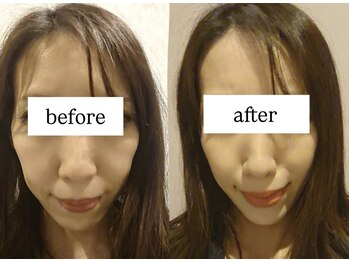 ビー ブルーム(B BLOOM)/【リフトアップ小顔】