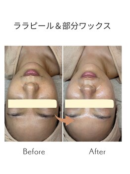 ジーンバイピエル 中野店(gene by PIEL)の写真/繰り返す肌荒れに/ララピール進化版で本気の肌質改善&LDMで水分補給【中野/韓国肌質改善】