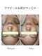 ジーンバイピエル 中野店(gene by PIEL)の写真/繰り返す肌荒れに/ララピール進化版で本気の肌質改善&LDMで水分補給【中野/韓国肌質改善】