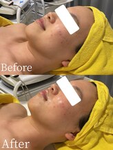 ミミーモリオカ(MiMiy MORIOKA)/小顔マシン×Dr.Arrivo施術1回目