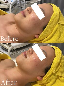 ミミーモリオカ(MiMiy MORIOKA)/小顔マシン×Dr.Arrivo施術1回目