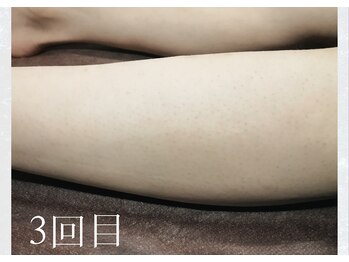 サロンドウルス(salon de ours)/メンズ　ヒザ下脱毛☆