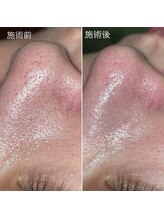 クレアーレ(creare)/ハイドロスキン・施術結果 1