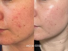 サロンディト(ditto)/サロン＋ご自宅で美肌ケア＊