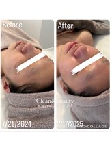クリーンアンドビューティ 札幌(Clean&Beauty)/ハーブピーリングで肌改善♪