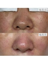 ライカブルー(RaicA BluE)/施術写真　before-after