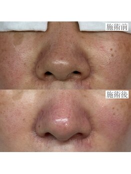 ライカブルー(RaicA BluE)/施術写真　before-after