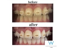 ホワイトニングショップ 三島店(WHITENING SHOP)/矯正中の方でも照射可能です♪