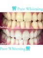 ピュアホワイトニング 横浜店&nbsp;セルフホワイトニング/横浜/医療提携ピュアホワイトニング