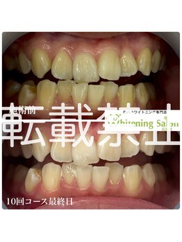 ホワイトニングサロン 広島店/【ホワイトニング10回照射】