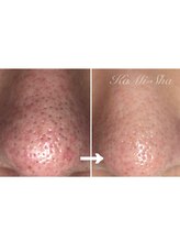 カミーシャ(KaMi-Sha)/【40代女性】毛穴改善症例写真