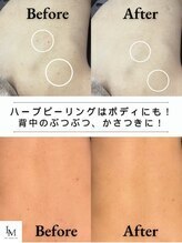 【毛穴|ハーブピーリング】韓国肌管理Belle 天文館 背中 ニキビケア