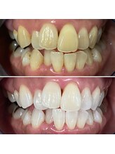 ホワイトニングサロン クルー(CREW)/