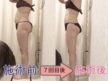 上野エステサロン レア(Lea)/ハイパーナイフ正規取扱店/上野