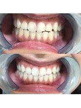 エクシアホワイト SOKA(ecxia white)/