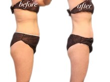 リリィブラン(Lily branc)/痩身上半身モニター様/お腹+腰