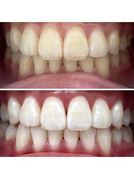 エクシアホワイトニング 日本橋店/ビフォーアフター