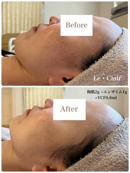 スキンセラピーサロン ル クレール(Le Clair)/Before→After
